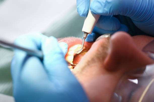 Best Emergency Tooth Extraction in Central City, NE