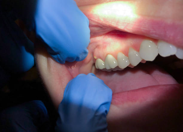 Best Emergency Tooth Extraction in Central City, NE